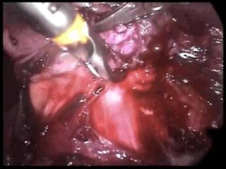 Coeliochirurgie d'un abcès tuberculeux du muscle psoas iliaque de la femme jeune